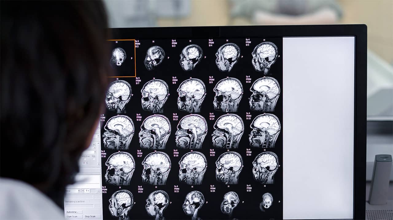 il CBD pu&ograve; provocare Ictus